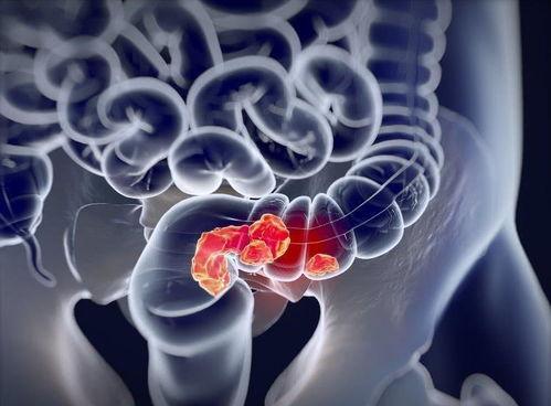 直肠癌的明星,直肠癌明星的康复之路